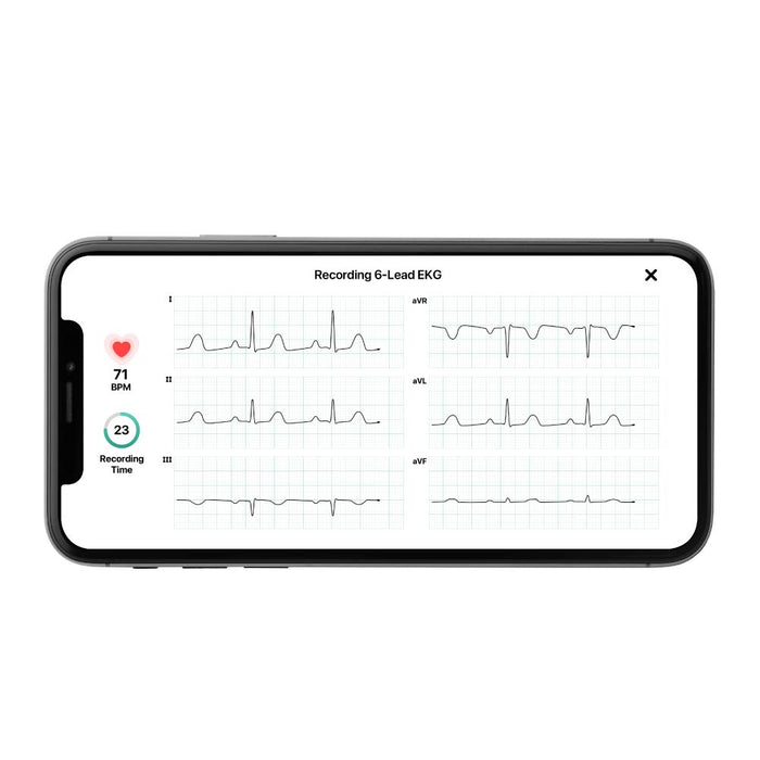 AliveCor's KardiaMobile 6L | FDA and CE Approved Personal ECG Device for iOS and Android | Wireless 6-Lead ECG | Detects AFib, Bradycardia, Tachycardia and Normal Heart Rhythm in 30 Seconds